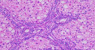 Liver Fibrosis and NASH: Entering a Critical Execution Phase