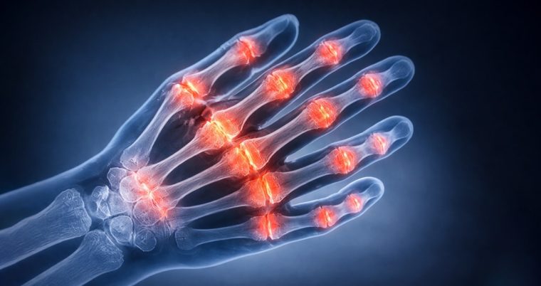 Rheumatoid Arthritis Is Entering a New Competitive Phase