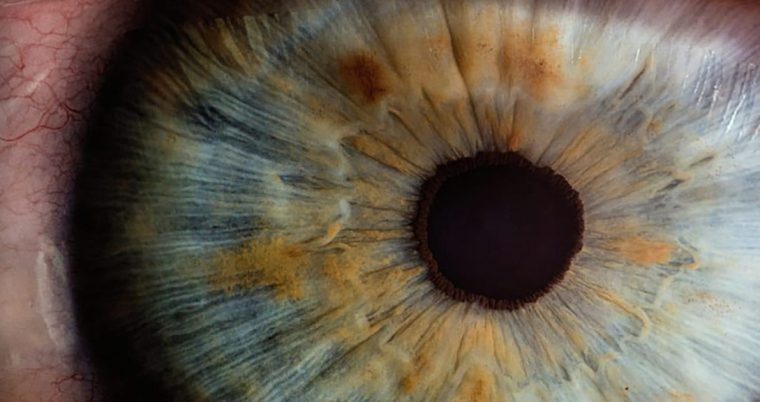 Beyond AMD: Breakthroughs in Geographic Atrophy